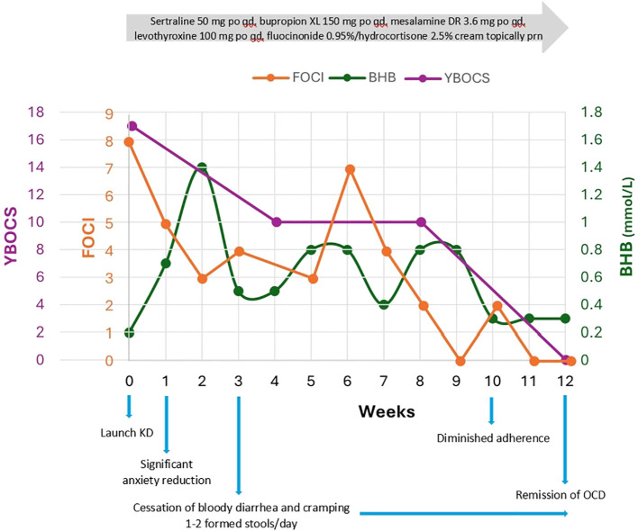UC and OCD Complete Remission with Ketogenic Diet