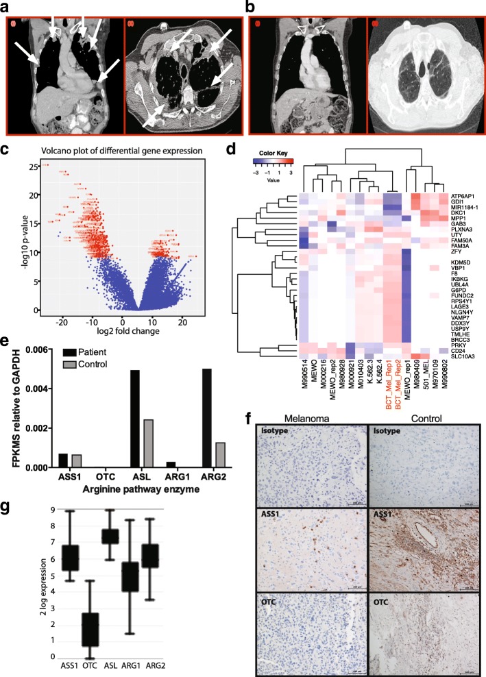 IO-Resistant Melanoma Complete Remission